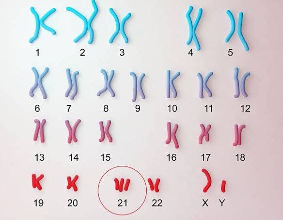 comparing cerebral palsy and down syndrome